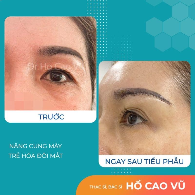 Nâng cung chân mày bao lâu thì đẹp và giảm hẳn sưng